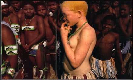 albinizm